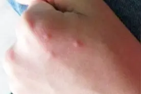 手上长红疙瘩后别不在意，有可能是病毒感染引起的，快去检查一下视频封面