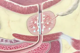 这5种食物有助于预防前列腺癌，男性朋友可多吃视频封面