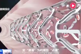 中国医疗器械首登《柳叶刀》“火鹰支架”破解心血管介入难题视频封面