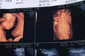 产检是女宝，生下来却是男宝宝，为什么会出现“胎儿翻盘”？视频封面