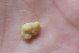 从嘴里吐出来的小石头，到底是什么东西？视频封面