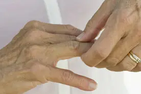 指关节肿痛，要注意了，那是风湿病早期的症状视频封面