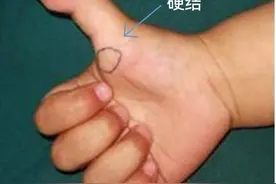什么是小儿扳机拇？图片