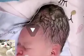 新生儿出生自带“古代发髻”，是产力不足导致，母婴都很遭罪图片