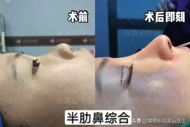 塌鼻头、大鼻孔，如何让鼻头“站起来”？图片
