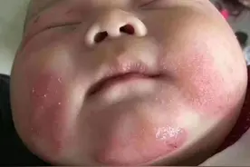 夏季抚触好处多，可“抚触油”湿疹宝宝要慎用，医生建议这样护理图片