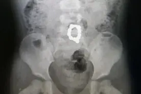 遵义2岁幼儿腹部疼痛达两个月，竟是误吞这东西，家长的做法心太大图片