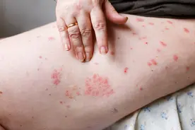 治疗湿疹，修复“屏障”是关键：4类药膏，你懂得怎么选吗？图片