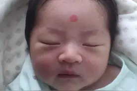 罕见病，天价药！90后妈妈和她的“象鼻宝宝”图片