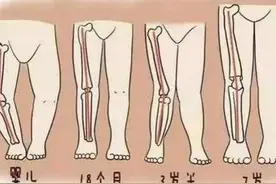 孩子腿弯，怎么判断是否有问题？图片