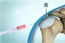 关节痛，打封闭针好不好？骨科医生带你认识真实的封闭针？图片