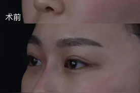 打玻尿酸隆鼻后，鼻子会变宽吗？图片