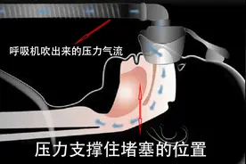 这篇文章让你从呼吸机小白变成呼吸机达人（1）图片