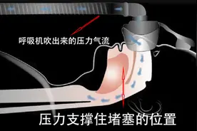 这篇文章让你从呼吸机小白变成呼吸机达人（1）图片