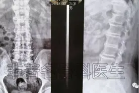 脊柱内镜下的ULBD治疗腰椎中央椎管狭窄（附详细图片）图片