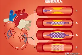心脏支架后能活几年？医生实话实说：支撑生命的是这4个关键点图片