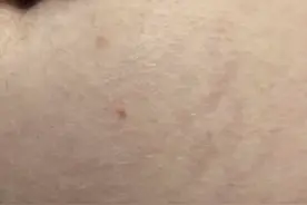对付妊娠纹，哪些产品好使？医生：买的都是智商税图片
