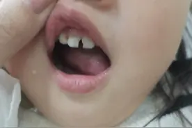 宝宝牙齿龋齿脱矿怎么办图片