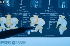 关于骨盆骨折治疗的那些事——你想不到，他们做得到图片