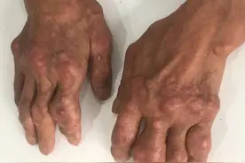 长痛风石有七个特点四个疏忽，去痛风石有三个方法降尿酸是关键图片