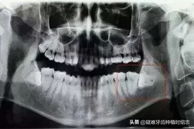 在智齿发炎时拔除=拿生命来拔智齿？图片