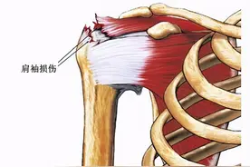 谈“骨”论“筋”之一：我们的肩膀怎么了图片