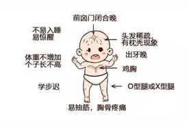 佝偻病的症状和临床特点图片