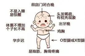 佝偻病的症状和临床特点图片