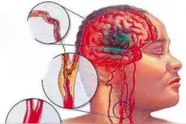 作为医生我必须告诉你，这种脑梗死无症状！图片