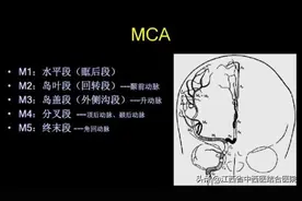 时间就是大脑！右侧大脑中动脉取栓术图片