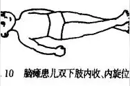为爱行儿童康复中心脑瘫儿双下肢处于内收，内旋位怎么进行训练?图片