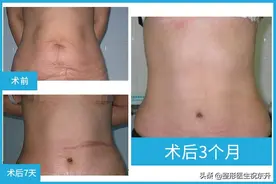 妈妈想做或者自己打算做“腹壁整形”的人，听我说几句真心话图片