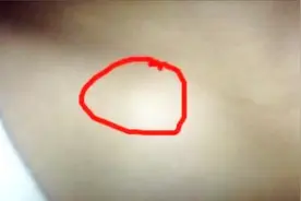 锁骨突出原来可以矫正！视频封面