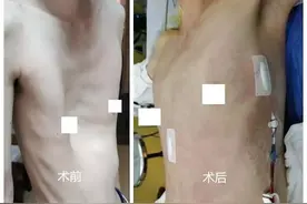 23岁女孩前胸贴后背，来广州求医，手术1小时后复原图片