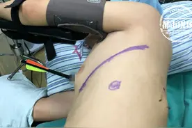 离心脏不过1厘米！男子遭弓箭穿胸，还是他自己射的图片