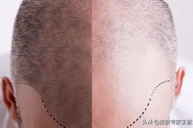 听说植发种的头发第二年就掉完了？皮肤科医生来告诉你真相图片