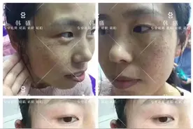 专业祛斑知识图片
