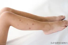 蚊虫叮咬真麻烦，教你几个小妙招图片