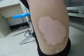 白癜风不治疗，多久会发展扩散？图片