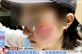 女大学生使用网红面膜后，脸颊出现大片红斑，​刺痛脱皮图片