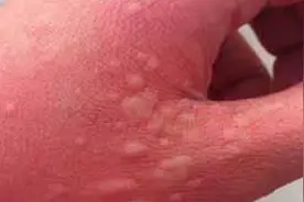 身上起红疙瘩，越抓越痒怎么回事？了解这七大诱因，还你光洁皮肤视频封面