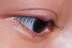 越来越多的人在这个季节得了睑板腺囊肿，该怎么办？图片