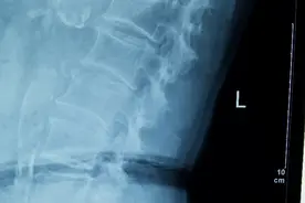 误诊分析：大腿外侧疼，不是椎间盘突出，而是髂胫束综合征！图片