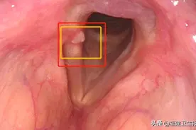 福州一男子每天吃2斤小番茄，咽喉长了个肿物！爱吃水果也是错？图片