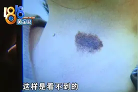 带女儿去除胎记，没除干净，还留了一大块疤图片
