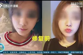 女主播做“隆鼻修复”结果鼻子塌陷几个坑 医院：抽烟导致感染图片
