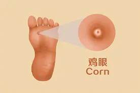 脚上为何会长鸡眼？长出的鸡眼要如何去除？告诉你几个好方法图片