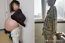 8年"养出"大肚子 竟是40斤病变肝脏——南昌大学二附院移植科成功完成一例巨大多囊肝移植手术图片