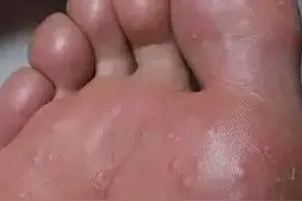 什么是脚气？用什么药治疗效果好？图片