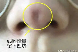 线雕隆鼻3个月，线体竟然穿出！即使这样，你们还要做吗？图片
